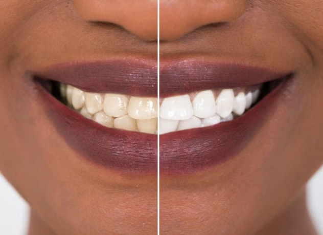 Teeth Whitening Strips