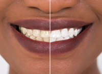 Teeth Whitening Strips