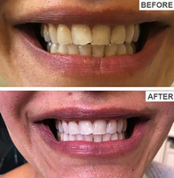 Teeth Whitening Strips